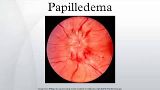 Papilledema [upl. by Enelehcim]