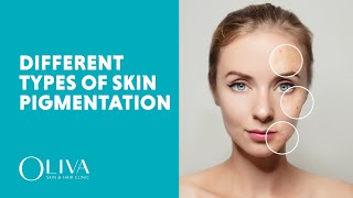 Types Of Skin Pigmentation  Causes  Best Practices  Oliva Pigmentation Treatment [upl. by Pollak]