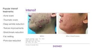 EndyMed Intensif MicroNeedling [upl. by Frieder]