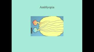 Difference between Myopia Near Sightedness amp Hyperopia FarSightedness [upl. by Allianora]