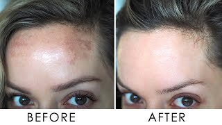 How I Got Rid Of Pigmentation  Melasma  Shonagh Scott [upl. by Einittirb]