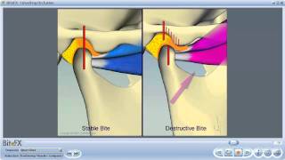 TMJ Disorders [upl. by Eatnoj548]