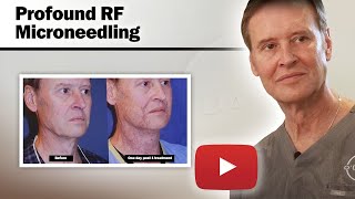 Profound RF Microneedling  Case Studies And Results [upl. by Arsi638]