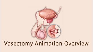 Vasectomy Animation Overview [upl. by Anicnarf]