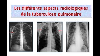 interprétation des clichés thoraciques tuberculosepulmonaire partie 1 [upl. by Naima850]