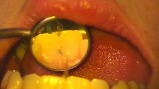 Filling Cavities in the Front Teeth [upl. by Arrait]