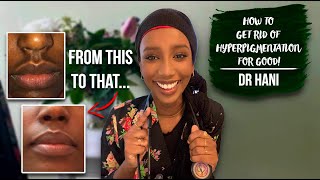 How To Get Rid Of Hyperpigmentation  Dr Hani [upl. by Hellman]