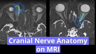 Cranial Nerve Anatomy on MRI [upl. by Issak]