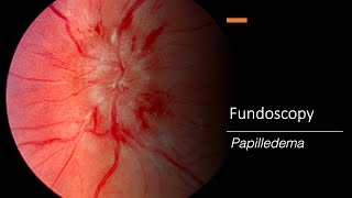 Papilledema Fundoscopy [upl. by Daraj236]