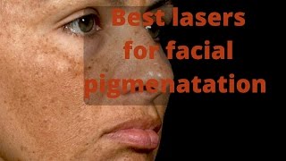 How to treat skin pigmentation [upl. by Eisej162]