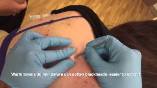 Blackheads back removal  the Australian Anaconda [upl. by Ahsemik]