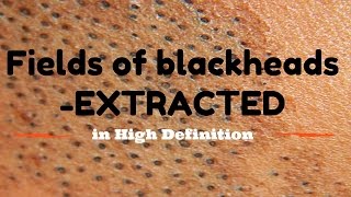 Blackhead fields extractions in HD [upl. by Byram]