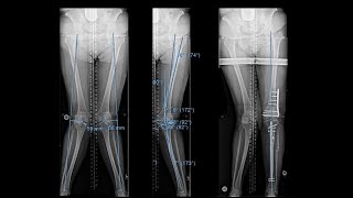 Midshaft Femur Fracture Intramedullary Nailing 3D Animation [upl. by Nnairda]