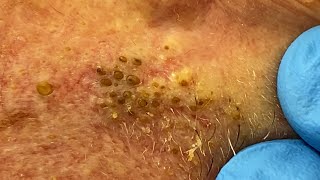 Extremely Clogged Pores Extracted  Contour Dermatology [upl. by Eirolam]