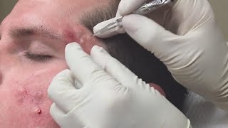 Super Satisfying Blackhead Removal [upl. by Low]