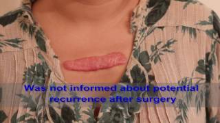 Chest Keloids  Mistakes to Avoid [upl. by Kcira]