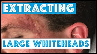 Acne Vulgaris and Extracting large Whiteheads  Part 1 [upl. by Devad]