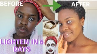 How I How i BRIGHTENED MY SKIN IN 6 DAYS REALISTIC and Natural way to reduce hyperpigmentation [upl. by Ynnek]