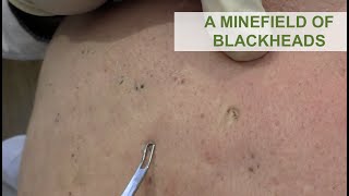 A Minefield of Blackheads  Dr Derm [upl. by Rochester]