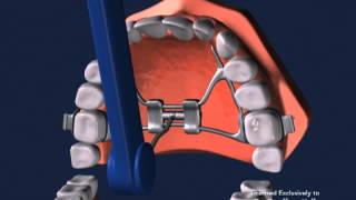 Advanced Orthodontics  Expanders [upl. by Tuttle957]