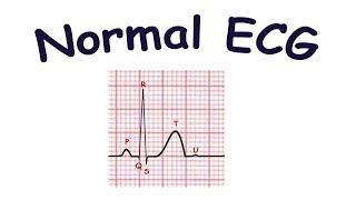 Normal ECG [upl. by Veal853]