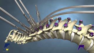 Decision Making in Adult Spinal Deformity [upl. by April]