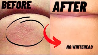 How To Remove Whiteheads And Blackheads From Chin At Home [upl. by Isle818]