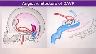 Right TransverseSigmoid Sinus Dural Arteriovenous Fistula [upl. by Ayatnahs890]