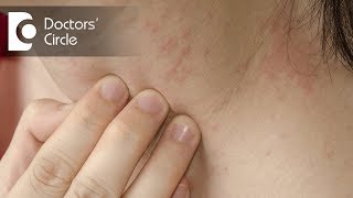 Four common rashes and everything you need to know about them [upl. by Breech61]