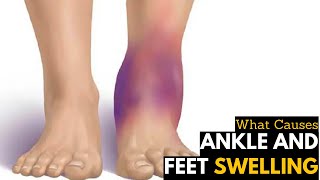 What Causes Ankles amp Feet Swelling  Diagnosis amp Treatment [upl. by Tami]