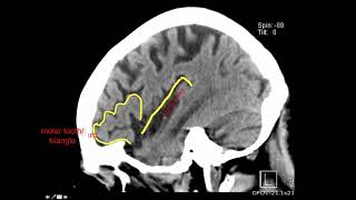 MRI Panic Attack 5 Tips to Help Ease Anxiety [upl. by Hatty900]