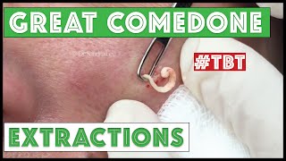 Greatest Blackheads and Whiteheads TBT [upl. by Tabber666]