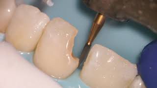 Teeth Bonding  Front tooth filling EXPLAINED [upl. by Cirnek356]