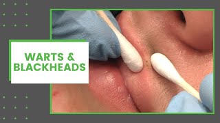 Warts amp Blackheads  Dr Derm [upl. by Ayoj]