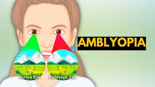 Successful Treatment of Amblyopia  Wow Vision Therapy [upl. by Ojahtnamas159]