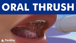 ORAL THRUSH  Candidiasis or yeast infection Angular cheilitis © [upl. by Riatsila362]