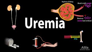 Uremia Pathophysiology Symptoms Diagnosis and Treatment Animation [upl. by Nolahp]