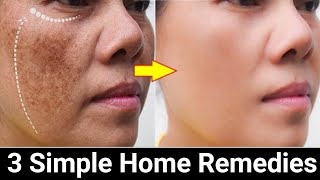 Remove Face Pigmentation Naturally [upl. by Oman]