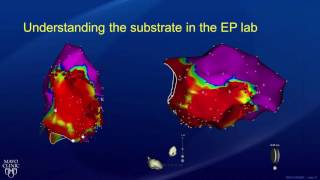 EKG Patterns  Premature Atrial amp Ventricular Contractions PACs amp PVCs [upl. by Einej]