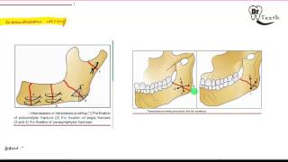 Mandibular Fractures  Part 2 MANAGEMENT [upl. by Adachi]