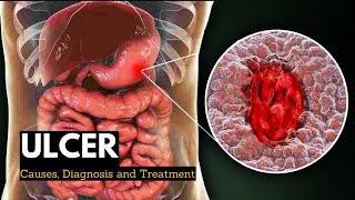 Ulcer Causes Signs and Symptoms Diagnosis and Treatment [upl. by Storm]