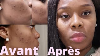 COMMENT se débarrasser des BOUTONS et TACHES sur le visage  ROUTINE Ducray  Samantha MK [upl. by Horvitz814]