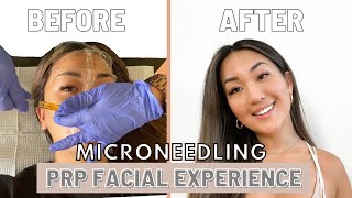 Full PRP Facial  Microneedling Experience  BeforeAfter Recovery [upl. by Ahsitruc287]