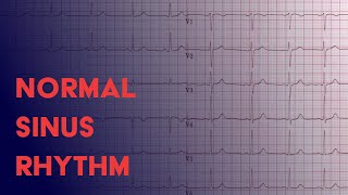 Normal Sinus Rhythm  EKG ECG Interpretation [upl. by Iruahs197]