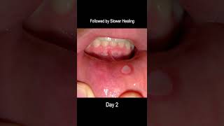 Causes Of Mouth Ulcers amp Treatment healthylifestyle health eatinghealthy healthcare mouthulcer [upl. by Lamrert]