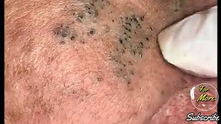 Dr Pop  Deep Blackheads in old Skin removing amp treatment 2020 Part 4 HD [upl. by Morley]