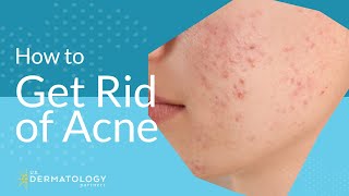 Acne Treatment  Explained by Dermatologist [upl. by Verne]