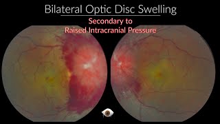 Papilloedema  Optic Nerve swelling [upl. by Elberta]