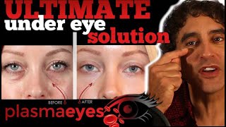 THE ULTIMATE UNDER EYE TREATMENT  PlasmaEyes [upl. by Aver]