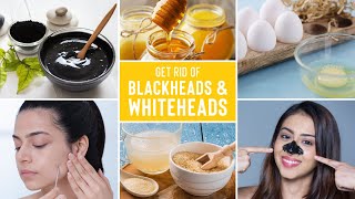 Easy Ways To Remove Blackheads And Whiteheads At Home [upl. by Swart]